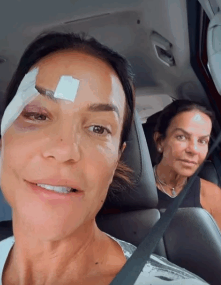 Com olho roxo após desmaiar, Ivete Sangalo comemora alta hospitalar